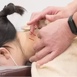 鍼治療とはなにか？どんな症状に効果があるの？どんな時におすすめ？のサムネイル